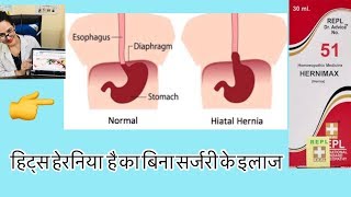 Hiatus Hernia Best Homeopathic Medicine हिट्स हेरनिया —का बिना सर्जरी के इलाज-डॉक्टर रुक्मणी