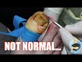 IF YOU GET INGROWN TOENAILS...WATCH THIS PLEASEEEE!!!!