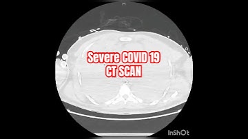 CT Scan Analysis in COVID-19: What the Images Reveal