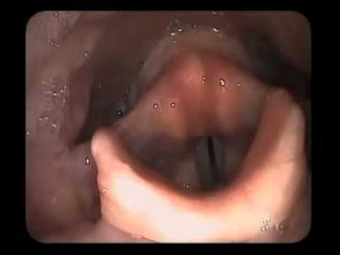Vocal Health Voice Stroboscope ENT Video (Vocal Cords/Folds in Action!)