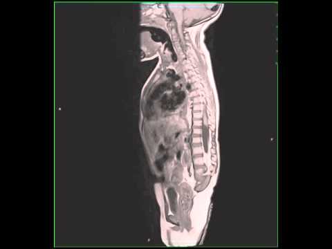 Caudal Regression Syndrome, secondary to maternal diabetes