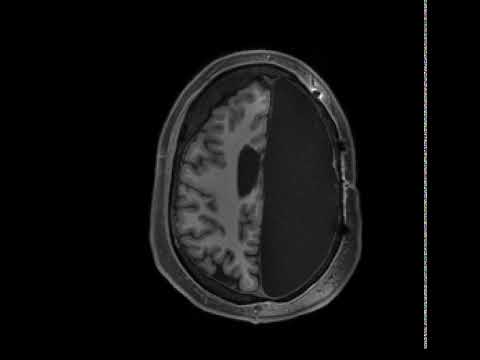 Resonancia de un cerebro sometido a una hemisferectomía