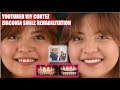 Viy Cortez Smile Rehabilitation | Apostol Dental Philippines