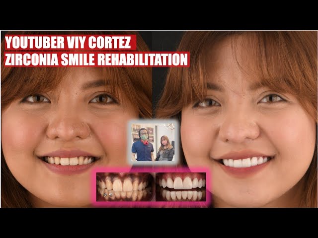 Viy Cortez Smile Rehabilitation  Apostol Dental Philippines 