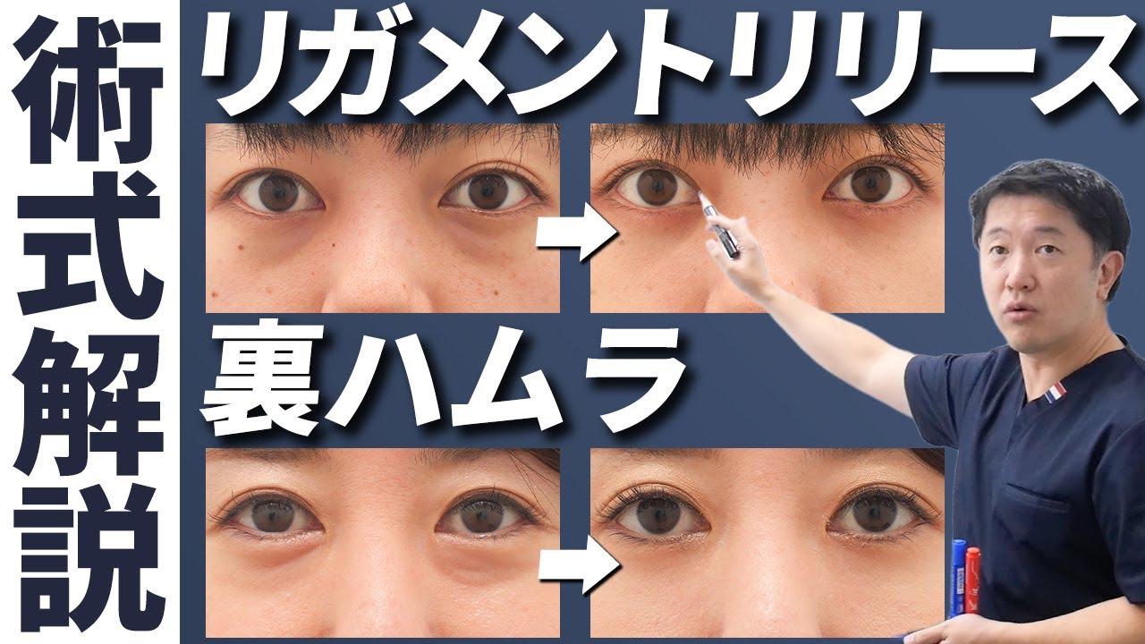 【術式解説】リガメントリリースと裏ハムラの違い