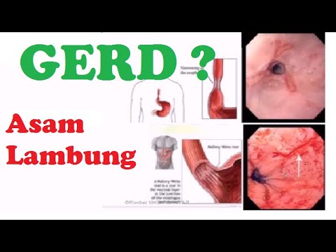 Video: Esofagitis Refluks - Pengobatan Esofagitis Refluks Dengan Pengobatan Tradisional Dan Metode