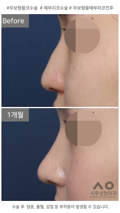 시우Tv Siwoo Plastic Surgery - Youtube