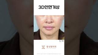 안면거상 1년차 비포&amp;애프터
