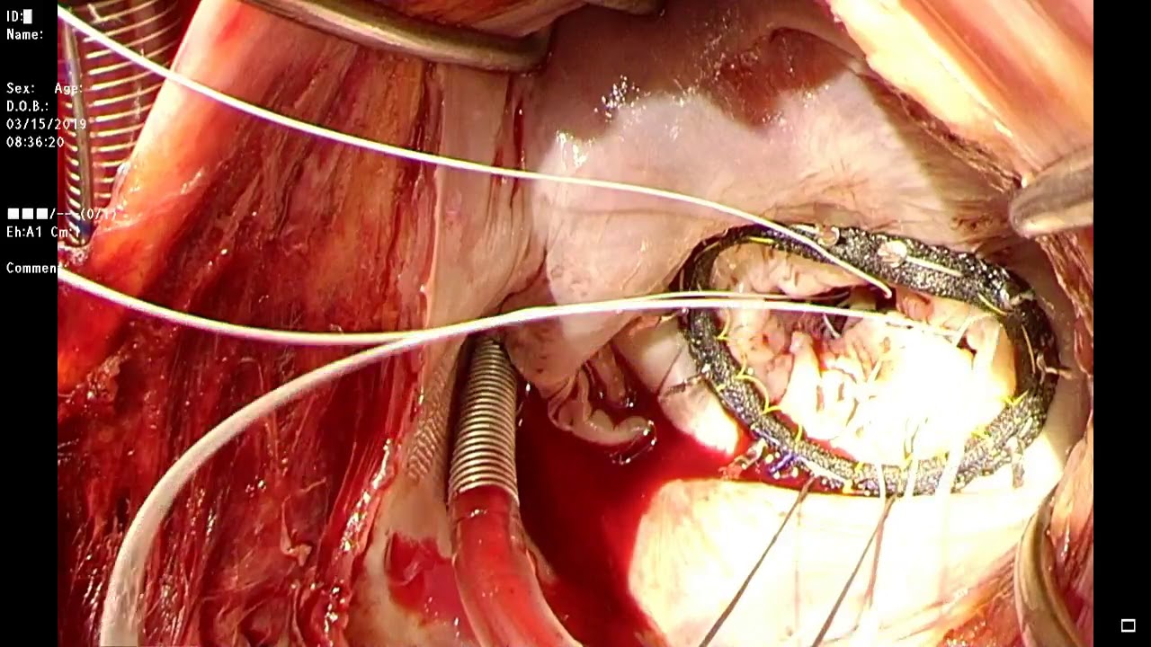 Mitral Valve Repair using Memo 4d rechord for P2 chordal rupture in FED