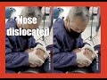 This man from Jakarta Indonesia  suffering from Nose dislocated problem