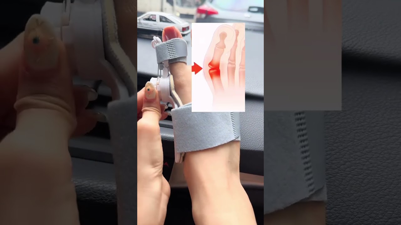 Tired of bunion pain? This adjustable bunion corrector gently realigns your toe 