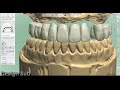 3shape design full arch case implant case osstem