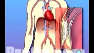 PreOp® Patient Education Stent Implantation Coronary Angiopl