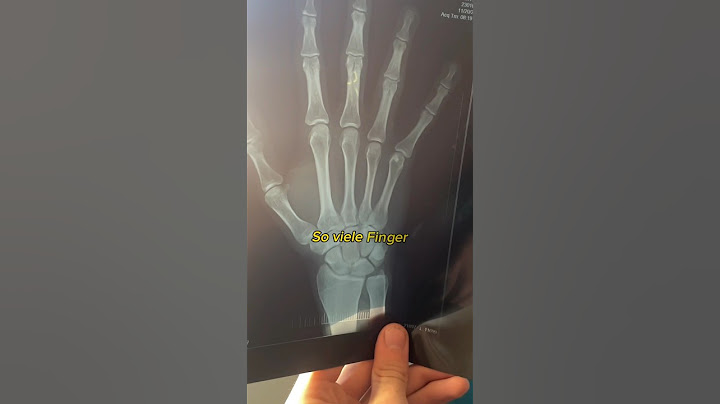 Finger beim Bungeejump gebrochen🙄