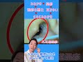 耳がかゆい/外耳道湿疹 #earcleaning