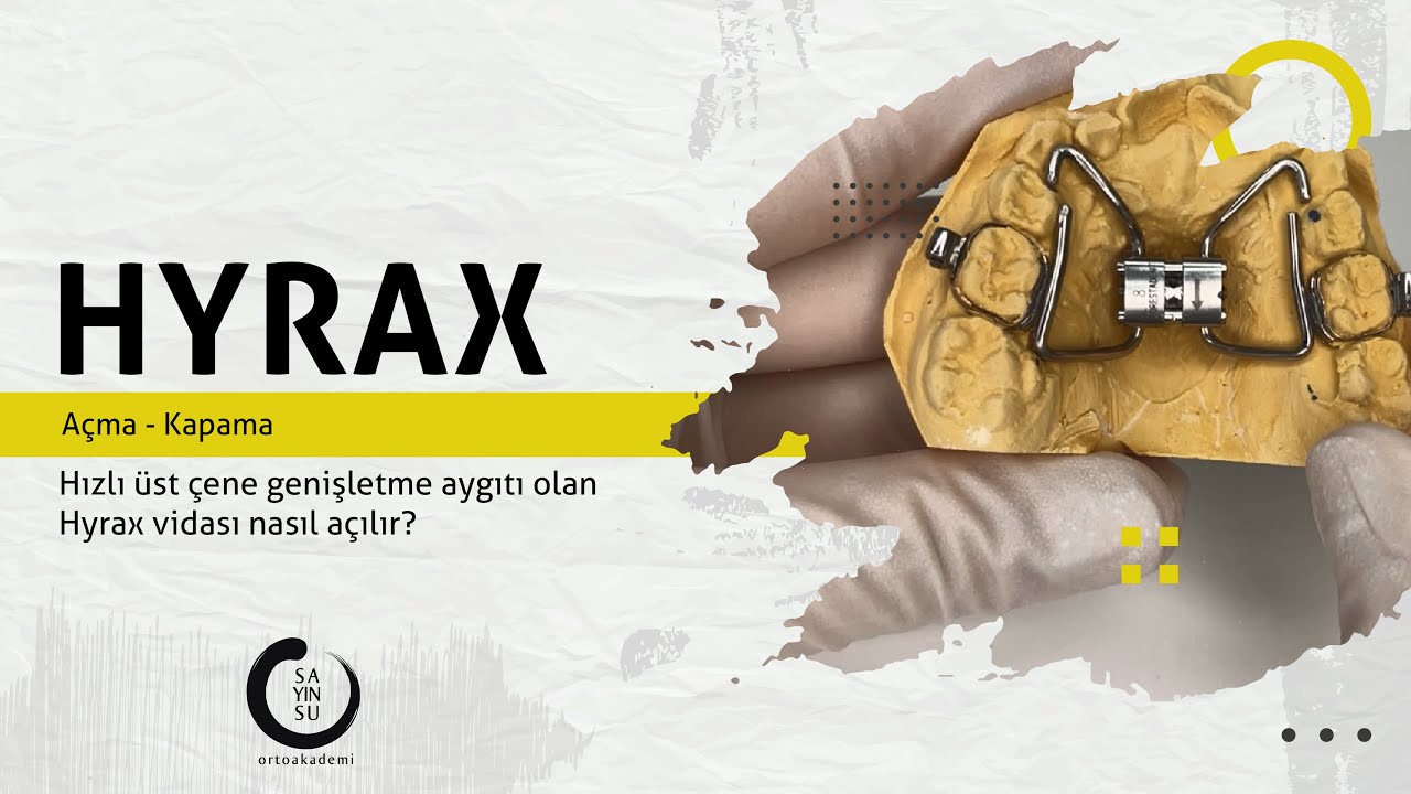 Üst Çene Genişletme Vidasının Çevrilmesi - Hyrax Vidası Açma