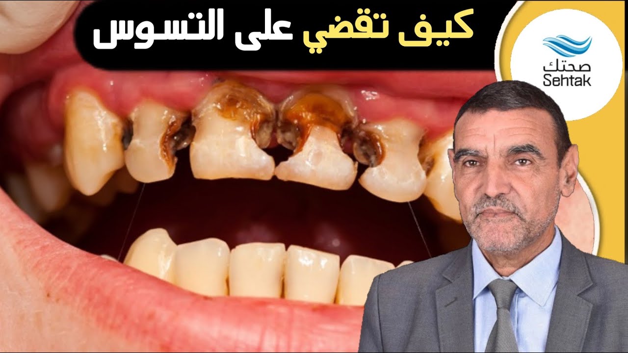 الدكتور محمد الفايد كيف تقضي على التسوس
