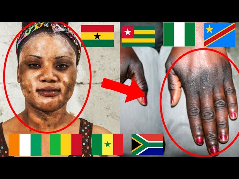 Vidéo: Pourquoi les Congolais blanchissent-ils ?