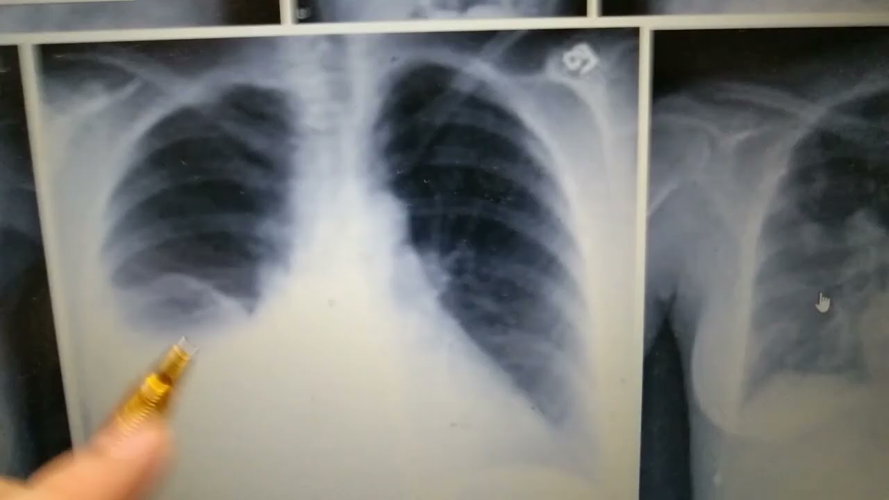 Pulmonology Radiology Pleural Effusion Chest X ray Loss Of Pulmonology Radiology Pleural Effusion Chest X ray Loss Of
