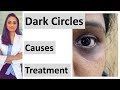 How to get rid of Dark circles | causes & treatment | creams, peels, lasers, fillers, home remedies