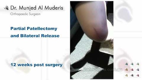 Partial Patellectomy and Bilateral Release - 12 weeks post surgery