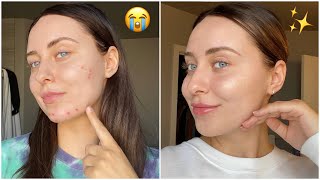 GIVING MY SKIN A MUCH NEEDED GLOW UP!