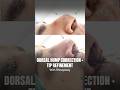 Dorsal Hump Rhinoplasty with Tip Refinement | Natural Nose Reshaping Results