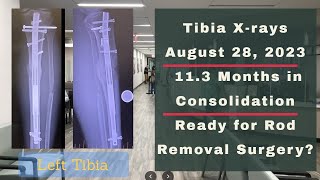 Height Journey - Tibia X-rays 11.3 Months In Consolidation - August 28, 2023