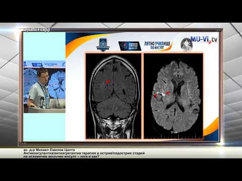 Видео: Последици от исхемичен мозъчен инсулт: ляво, дясно