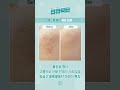 [여드름 롤링형흉터]  둥글고 울퉁불퉁 흉터가 발생하여 치료로 개선한 사례