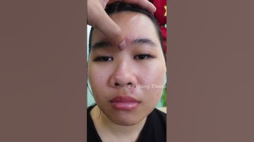 Nhiều bạn thắc mắc về cắt mí kết hợp mở góc mắt – hôm nay cùng xem thực tế một trường hợp nhé !