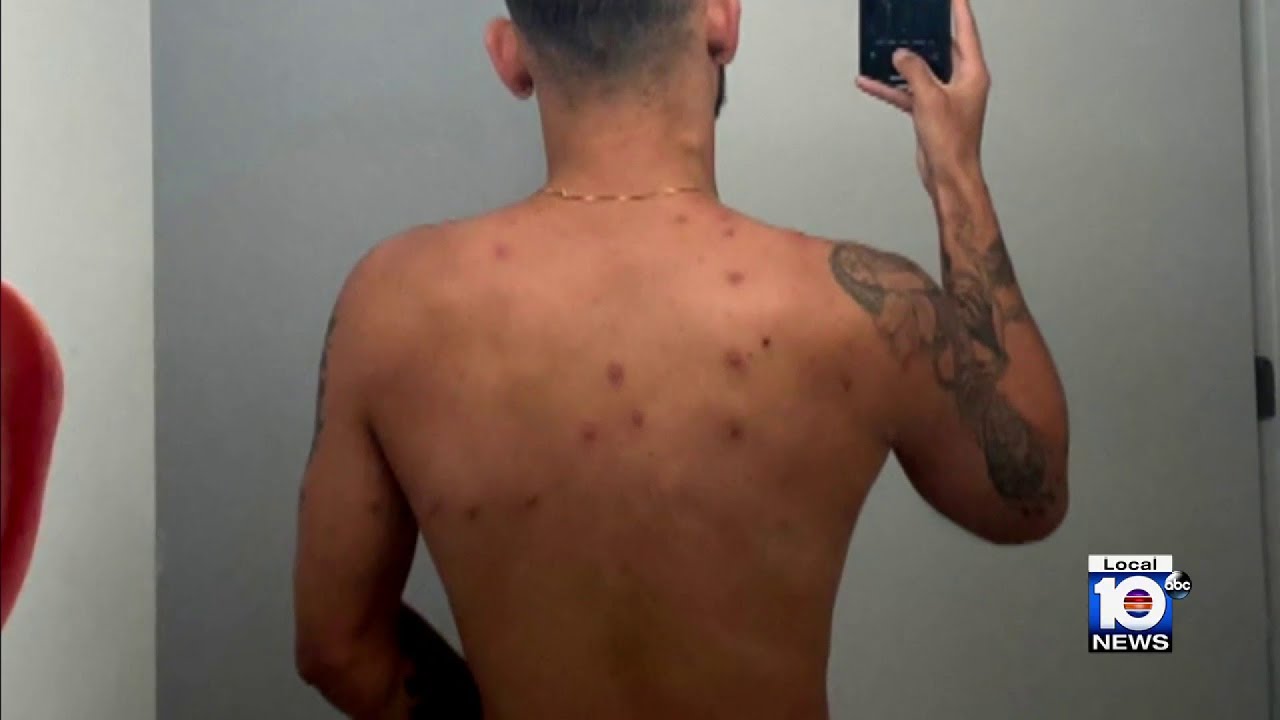 Monkeypox rash and scars: What does monkeypox look like? - ABC News
