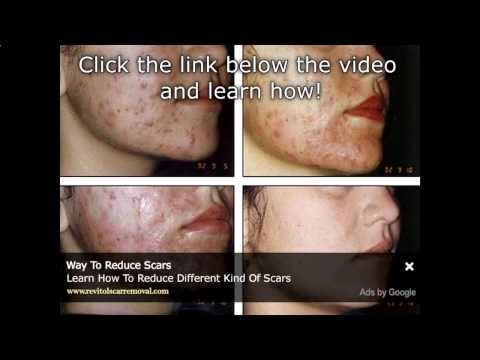 Watch Bio-Oil Review For Acne Prone Skin - Bio Oil Acne ...