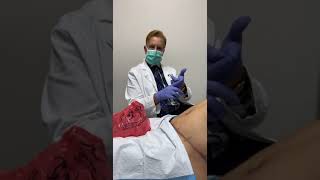 DRAIN REMOVAL 5 DAYS AFTER A TUMMY TUCK BY DR GABRIEL PATINO 06 16 2021