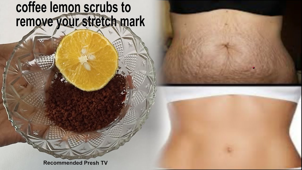 Use Coffee Lemon Scrubs To Removed Stretch marks Visible Clear skin