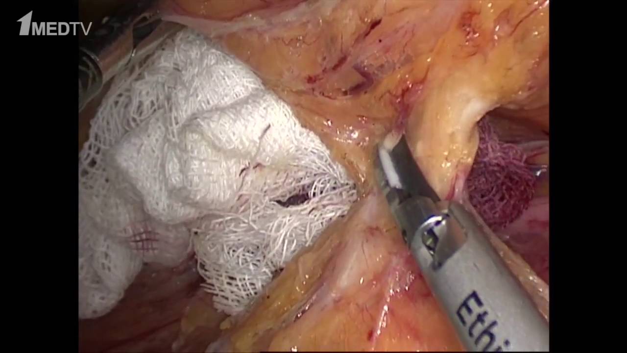 Резекция сигмовидной кишки – видео операции