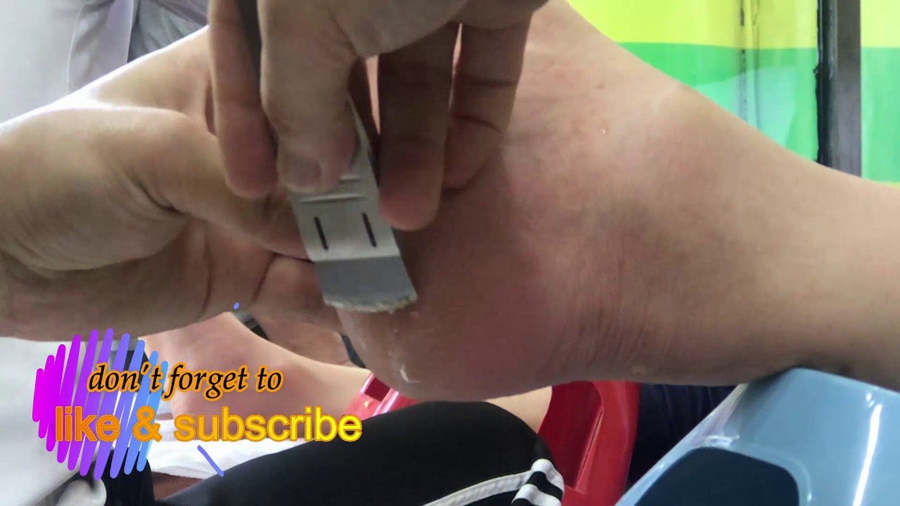 EXTREME FOOT CALLUS REMOVAL SATISFYING CALLUS REMOVAL YouTube