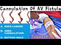 How to cannulate fistula  types of av fistula cannulation