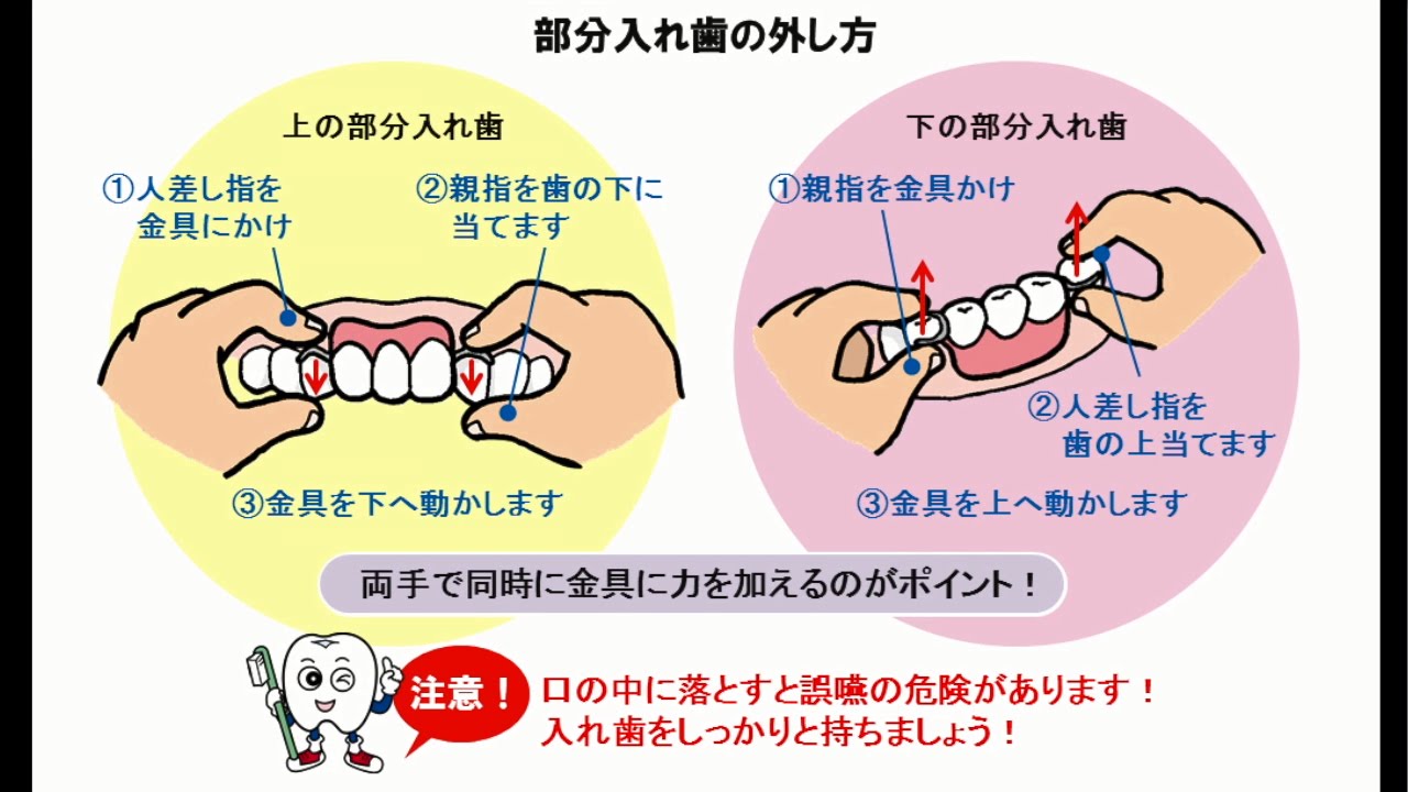 部分 入れ歯 の 外し 方