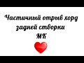 Частичный отрыв хорд задней створки митрального клапана на ЭхоКГ. Молотящая створка МК.