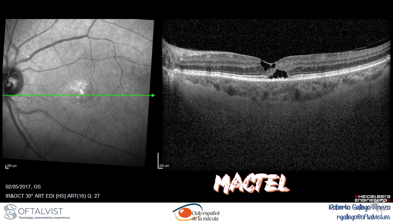 Valor real de la interpretación de la OCT YouTube Valor real de la interpretación de la OCT YouTube