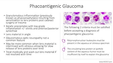 Lecture: Phacoantigenic Glaucoma (1 Slide in 5 Minutes)