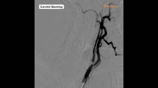 Presenting a successful Carotid Stenting performed on our First International Cathlab in Iraq.