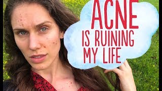 ❤️ How Having Acne Taught Me To Love Myself