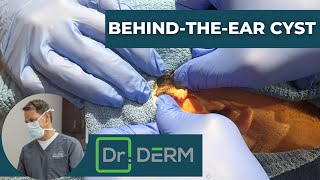 Behind-the-Ear Cyst | Dr. Derm