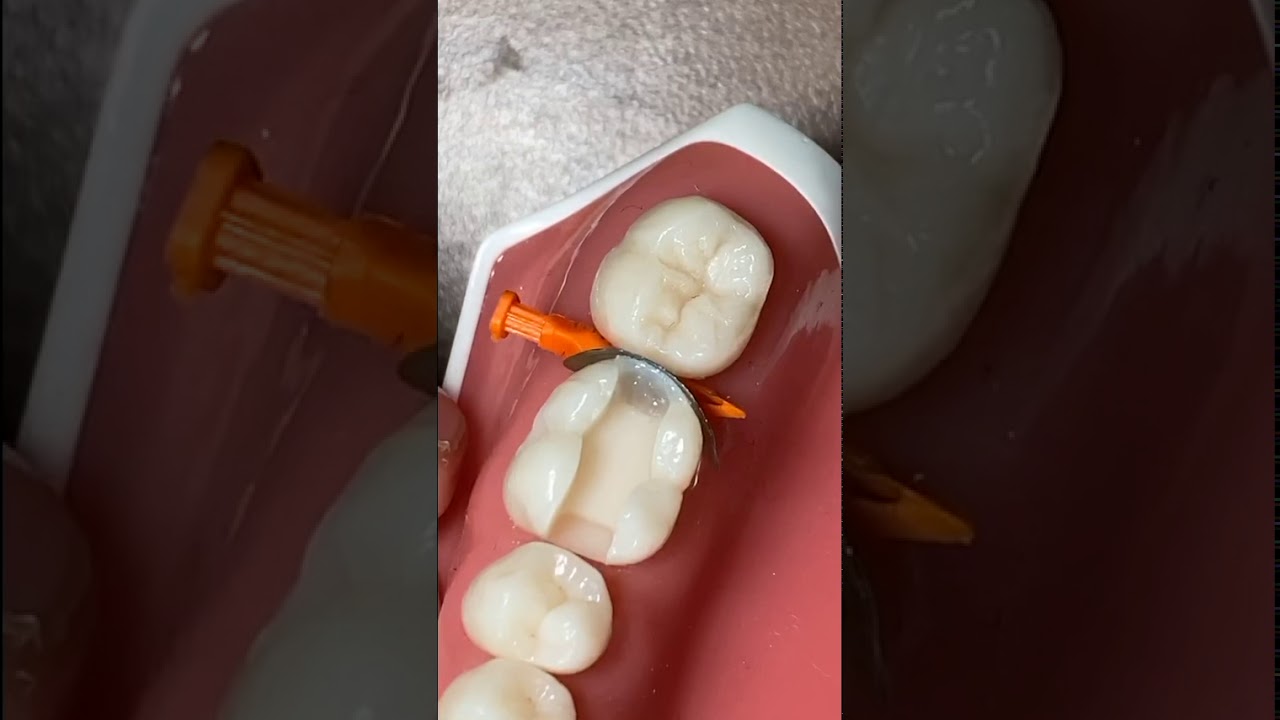 Класс II MOD нижний первый моляр Instagram Live 6 апреля 2020 г. Часть 1