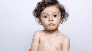 10 things to know about measles ❇️ Knowledge for Health