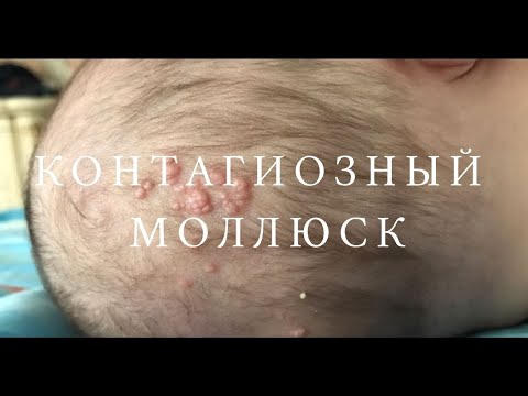 Контагиозный моллюск