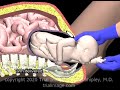 Fetal Dystocia Maneuvers to relieve Compound Presentation Animation by Cal Shipley, M.D,