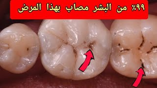 تسوس الاسنان السطحي ٩٩٪ من البشر مصاب به ما هي مضاعفاته و طرق علاجه